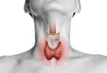 کم کاری تیروئید : از علائم اولیه تا درمان‌های موثر